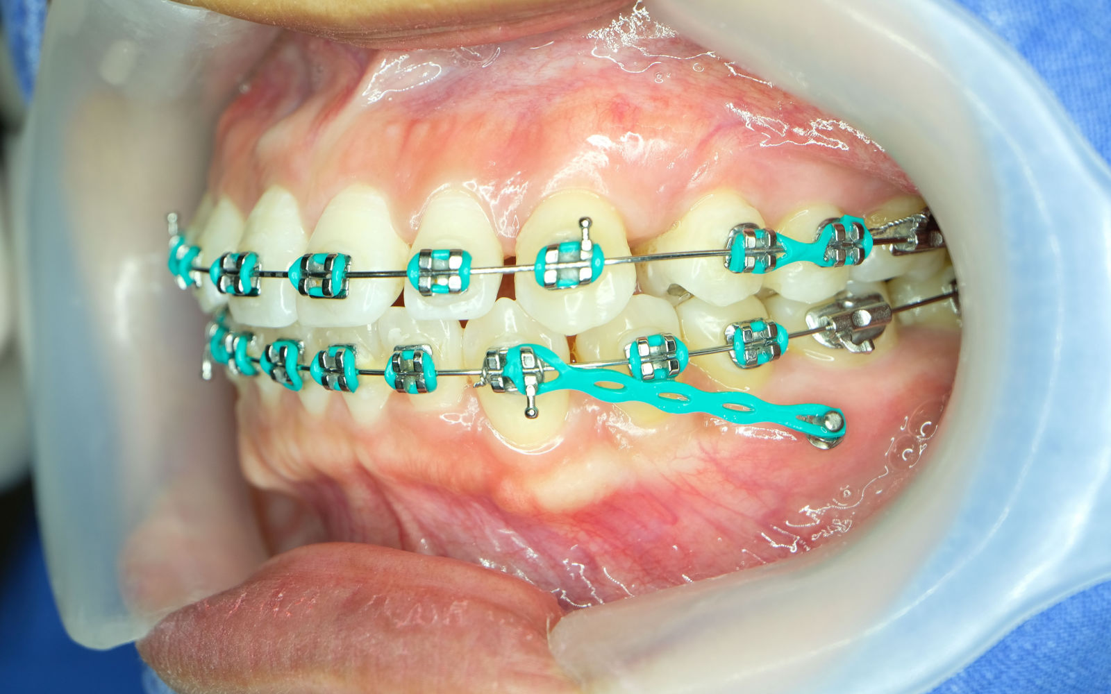 Orthodontic anchorage
